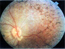 原发性视网膜色素变性