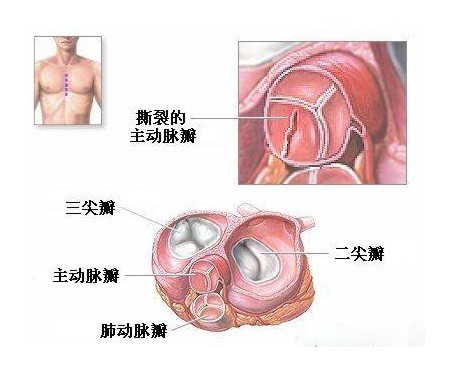 主动脉瓣钙化