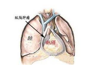 纵隔神经鞘源性肿瘤