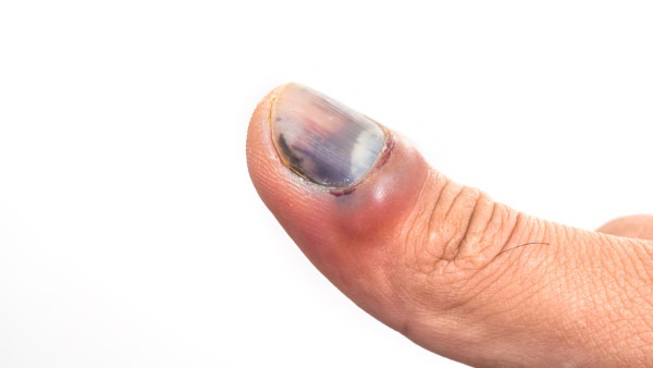 灰指甲该如何治疗 治疗灰指甲用什么药