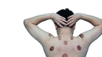 男人患有前列腺炎如何治疗比较好 治疗前列腺炎最好的办法