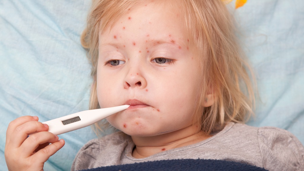 帶狀皰疹傳染嗎 帶狀皰疹的易感人群有哪些