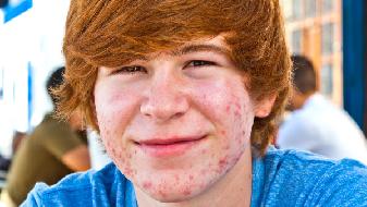 人们要警惕成人痘和鬼剃头 过度劳累皮肤会出现哪些症状