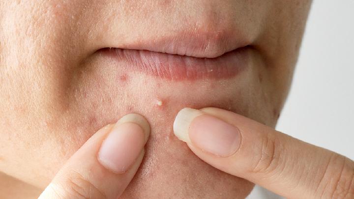 嘴角经常长痘原因有哪些 嘴角长痘如何护理