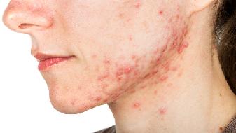脸上长痘是什么原因 不同类型的痘痘治疗办法