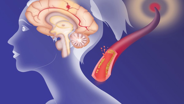 腦炎會(huì)導(dǎo)致記憶力喪失嗎 腦炎的治療方法都有什么