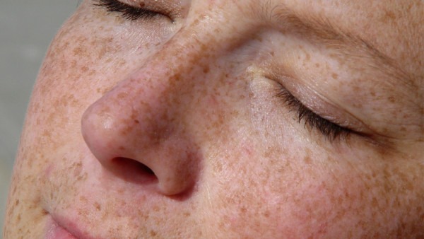 脸上长斑怎么除掉 脸上长斑的治疗方法有哪些