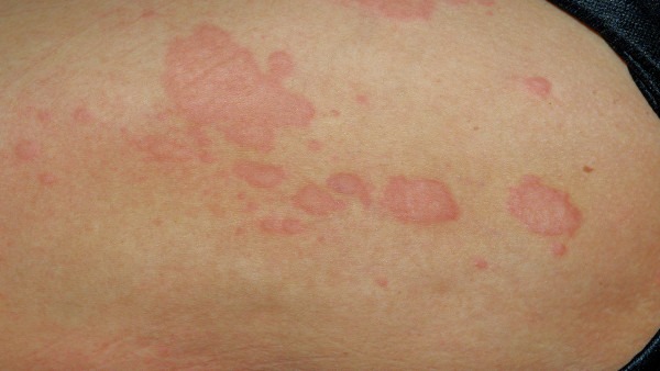 帶狀皰疹的危害有哪些 帶狀皰疹會引發癌變嗎