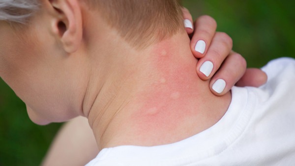 带状疱疹的诱发因素有哪些 带状疱疹有哪些症状