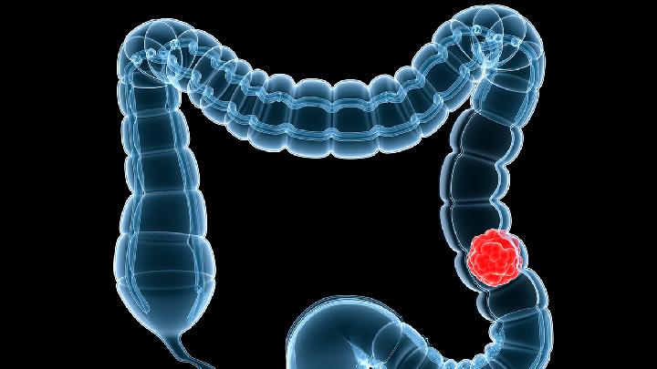 谈谈良性结肠肿瘤病因