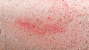 类风湿关节炎患者可能出现红斑狼疮的症状