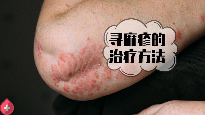 四方面入手了解白癜風(fēng)癥狀表現(xiàn)