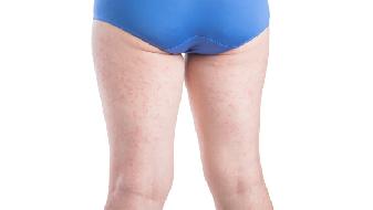 女性卵巢囊腫早期會有哪些癥狀表現(xiàn)?
