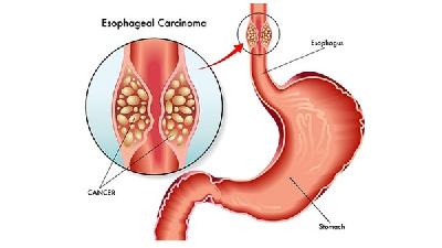 治疗宫颈肥大的三个有效的方法