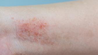 成年人得了湿疹应该怎么办？
