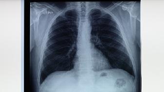 间质性肺气肿的诊断