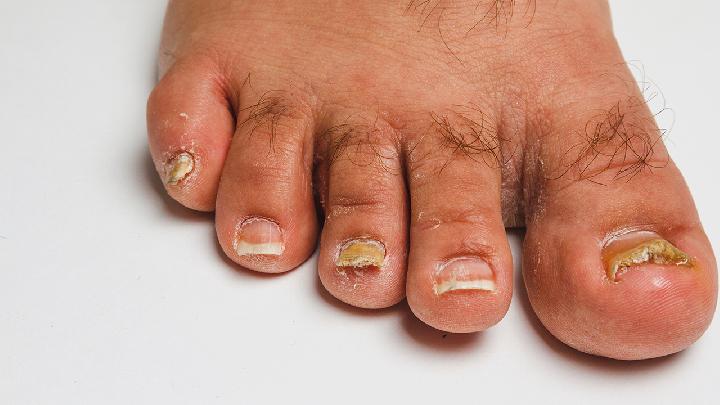 脚上灰指甲会导致寿命减少吗