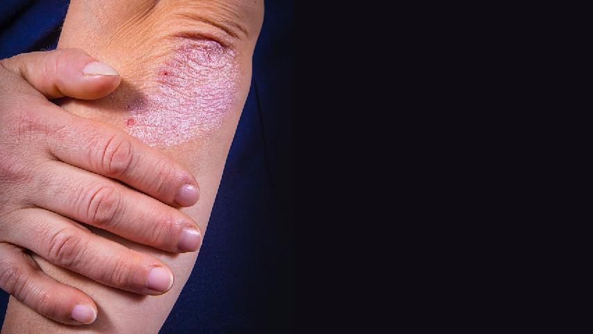 老年人牛皮癣究竟是如何引起的