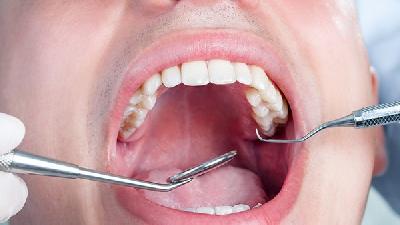 牙结石洗牙护理的五大作用