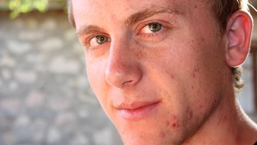 痤疮症状及有哪些