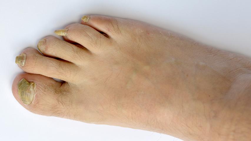 灰指甲的癥狀什么樣