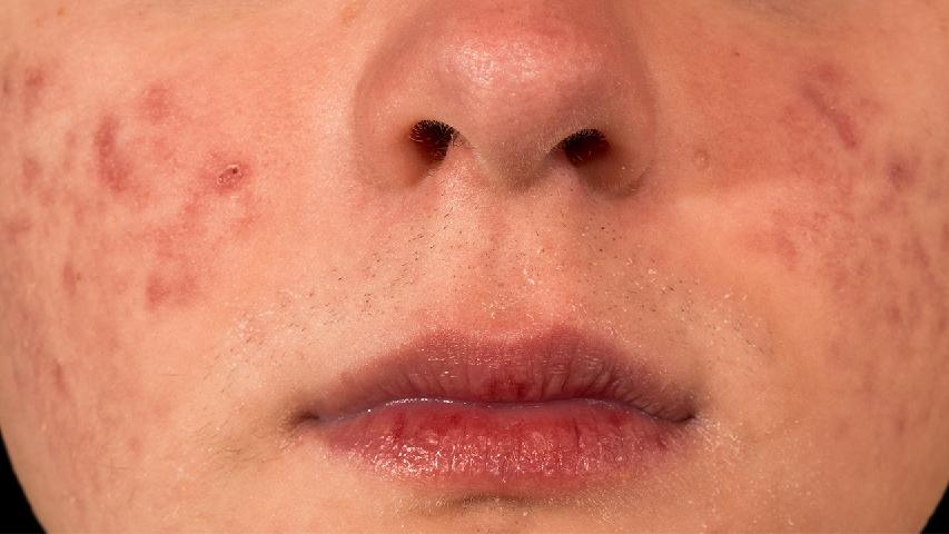 痤疮开始是什么症状