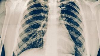 胸呈桶状谨防慢阻肺