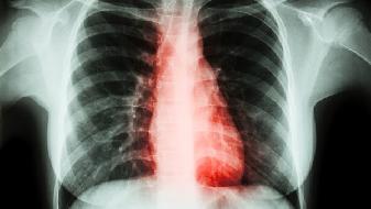 慢阻肺应与哪些疾病鉴别