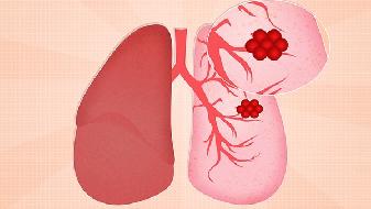怎么检查慢阻肺