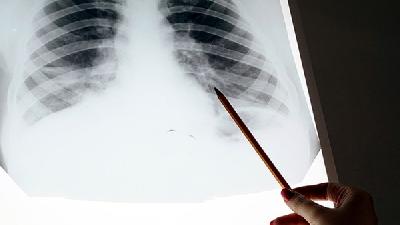 慢阻肺的预防常识