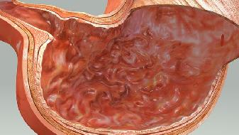 常用的治疗胆囊息肉的方法是什么?