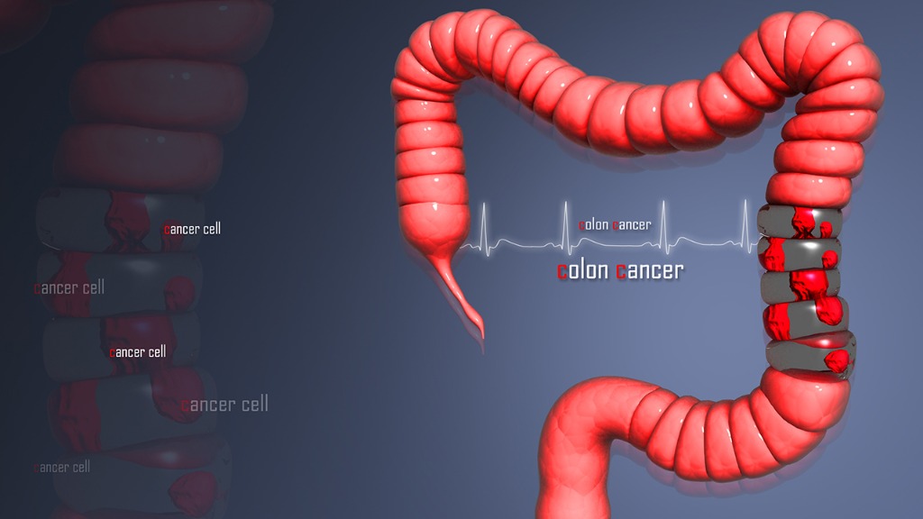 结肠癌是什么 结肠癌中晚期能治愈吗