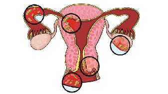 细菌性阴道病也会导致不孕