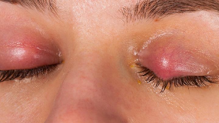 红眼病的六大检查方法