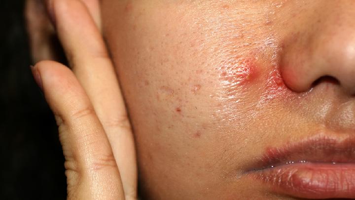 怎么去掉脸上的痘疤 祛痘印必用5种方法