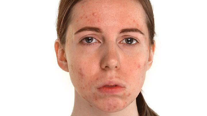 夏天你怎么得到痤疮皮肤护理 推荐四个祛痘的方法