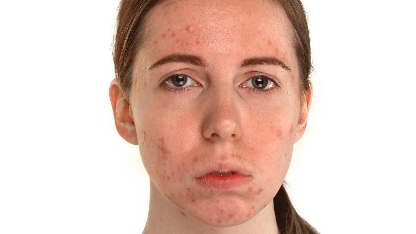 脸上如何预防长痘痘 让脸上不长痘的6大诀窍