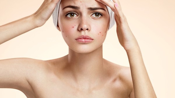 生活中该如何防治粉刺 防治面部粉刺的6个方法