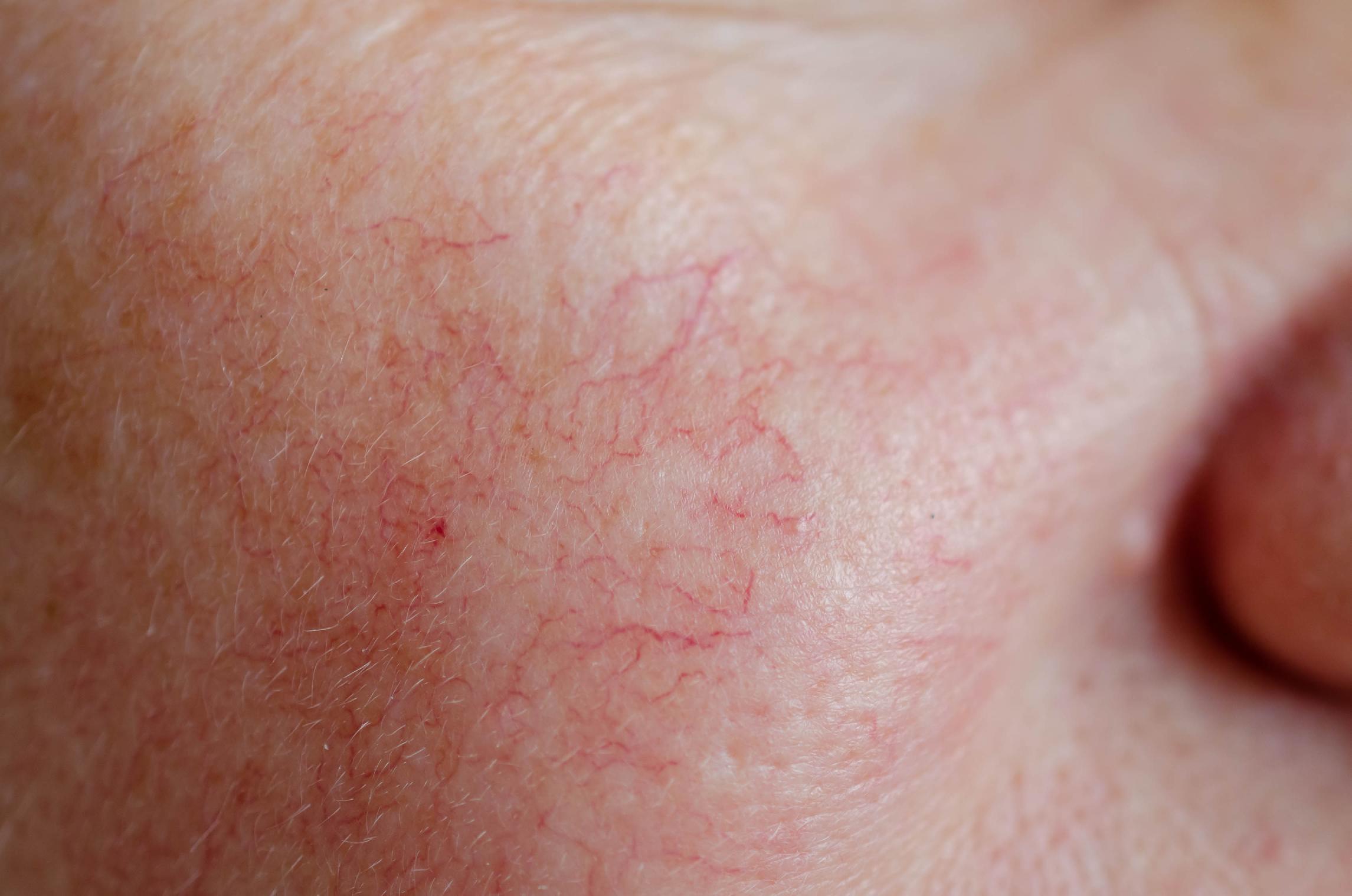 为何做激光祛痘脸上出现红点 选激光祛痘时建议先查身体