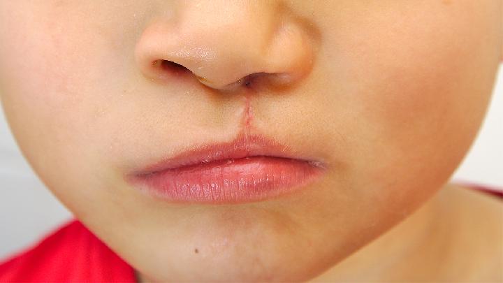 冬季5大唇部问题对症解决 教你如何保持双唇水润