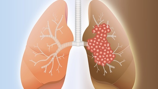 继发性肺结核的诱发因素都有哪些 继发性肺结核该如何用药