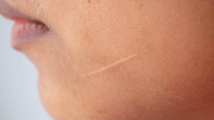 激光祛痘印会不会留疤痕 专家指出激光除痘印不留疤痕