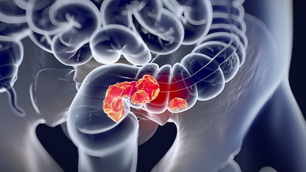 腹膜炎引起的肠梗阻该怎么进行治疗 腹膜炎引起的肠梗阻的非手术疗法都有哪些