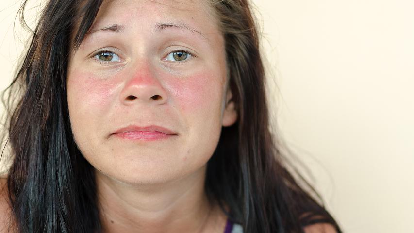 脸上皮肤粗糙怎么办 5方法有效预防皮肤粗糙