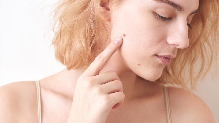 女性更年期容易出现黄褐斑 女性5大时期容易出现斑点