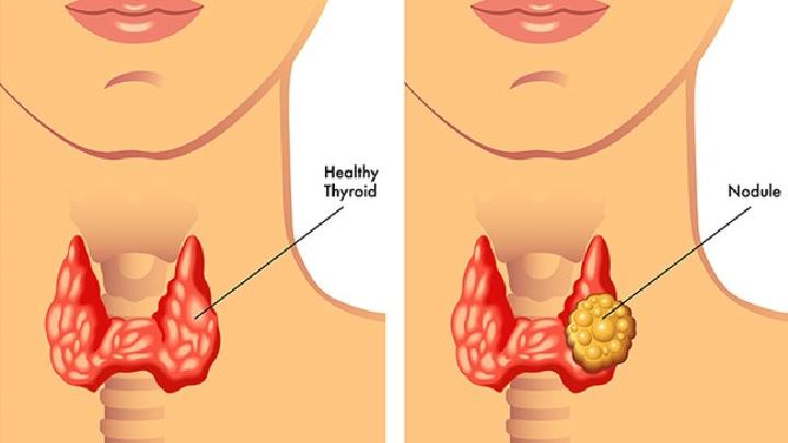 咽扁桃体肥大的食疗有哪些