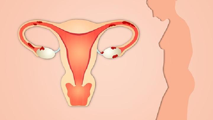 子宫内膜异位症会有什么症状