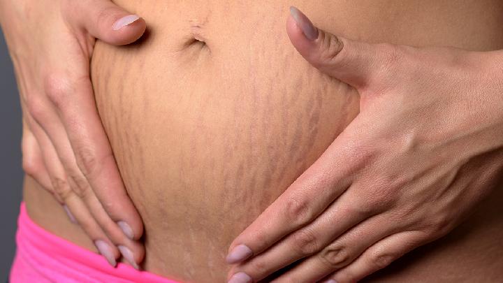 孕妇如何预防留下妊娠纹