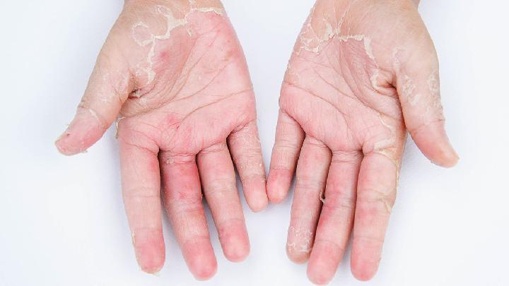 如何治疗皮肤淋巴细胞浸润症