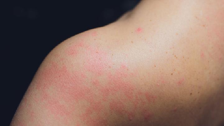 水痘的症状是什么